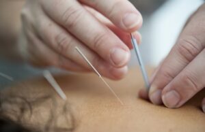 Anestesia con Acupuntura: El poder mental sobre el dolor