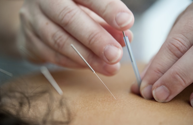 Anestesia con Acupuntura: El poder mental sobre el dolor