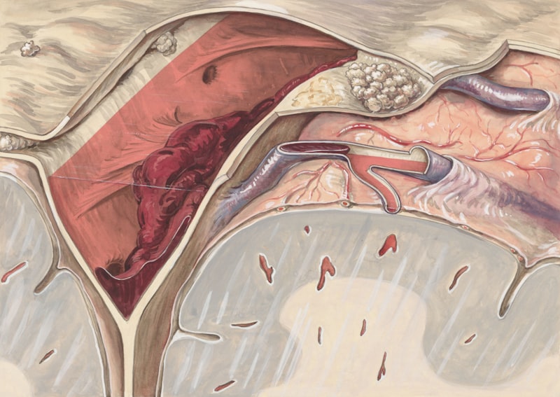 Arteritis: El impacto emocional tras la inflamación vascular
