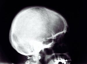 fijación anormal - abnormal fixation