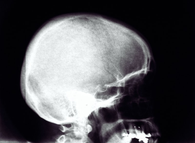 fijación anormal - abnormal fixation